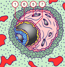 media/module10/f2r_implant12j3.gif