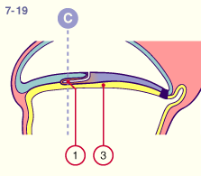 media/module22/v2q_h2_cstad7_19.gif