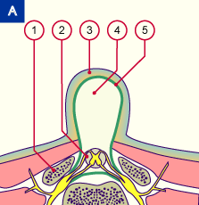 media/module7/h6b_meningozele_b.gif