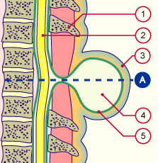 media/module7/h6b_meningozele_a.gif