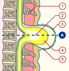 media/module7/h6c_myelomeningo_a.gif