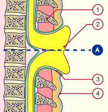 media/module7/h6d_myeloschisis_a.gif